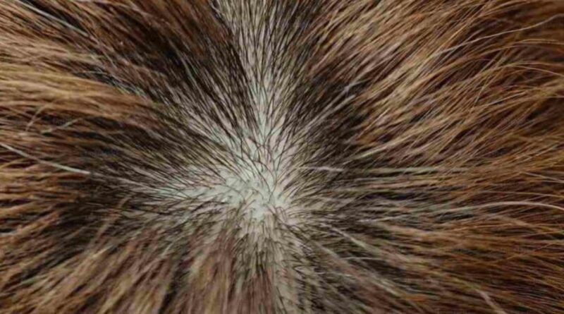 Best Hair loss Treatment 2024