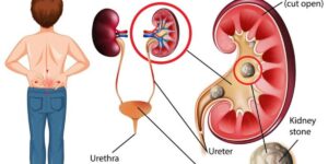 Understanding Kidney Stone Sizes