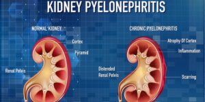 Kidney stones that are less than 4mm