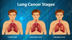 The Emotional Value of the Lung Cancer Bow