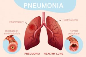 The Lung Cancer Bow in Education