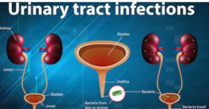 Can a urinary tract infection go to the kidneys?