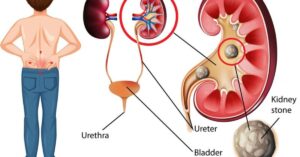 10 Telltale Signs You're Suffering with a Kidney Stone