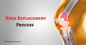 The Knee Replacement Process Explained